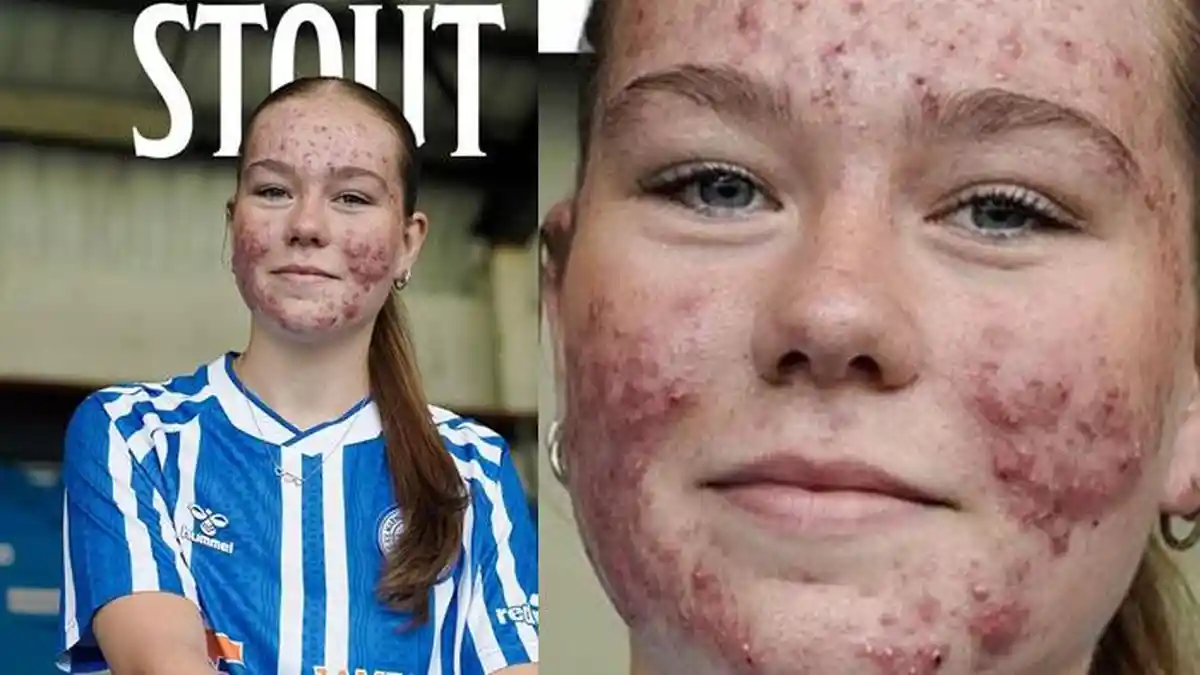 Kondisi Wajah Skye Stout, Pemain Bola Wanita yang Jerawatnya Jadi Bahan Bullyan Netizen Sedunia