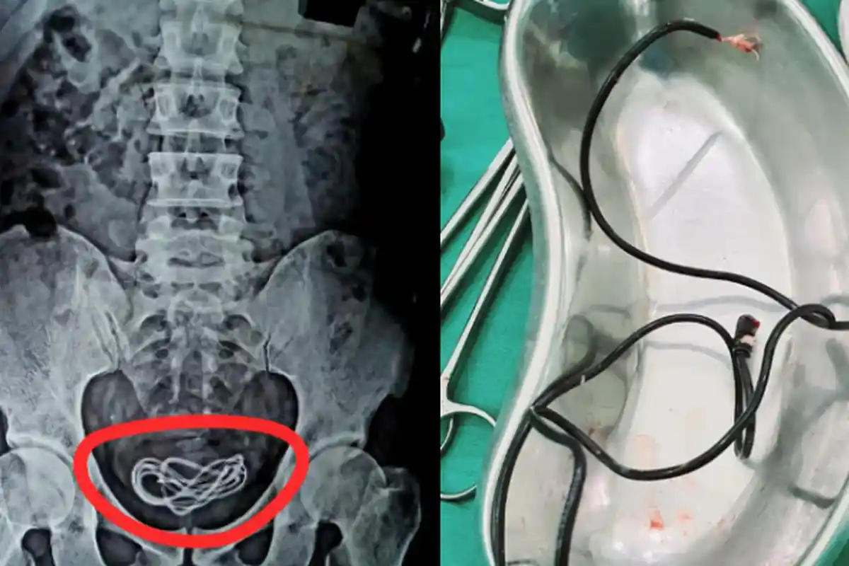 Dokter Terkejut Temukan Kabel Carger Handphone di Kandung Kemih Pria Ini