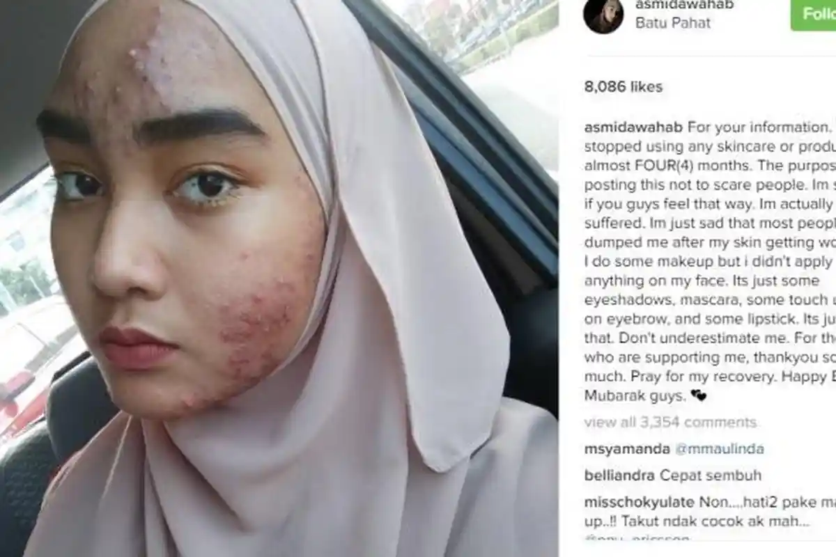 Gara-gara Pakai Produk Skin Care, Wajah Mulus Gadis Ini Malah Jadi Jerawatan Begini