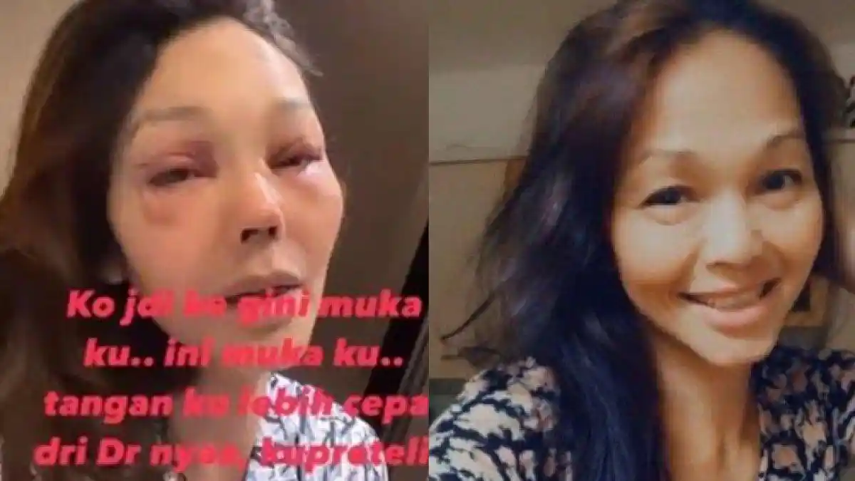 Penampilan Baru Bunda Corla, Syok Lihat Wajah Sendiri Setelah Operasi Plastik