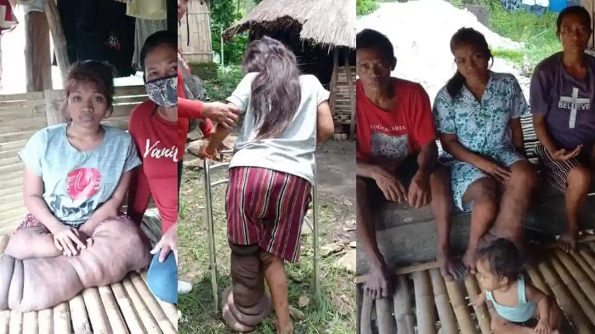 Penyakit Kaki Gajah Membuat Gadis asal Sumba Ini Sulit Berjalan, Diduga Ada Kelainan Lain
