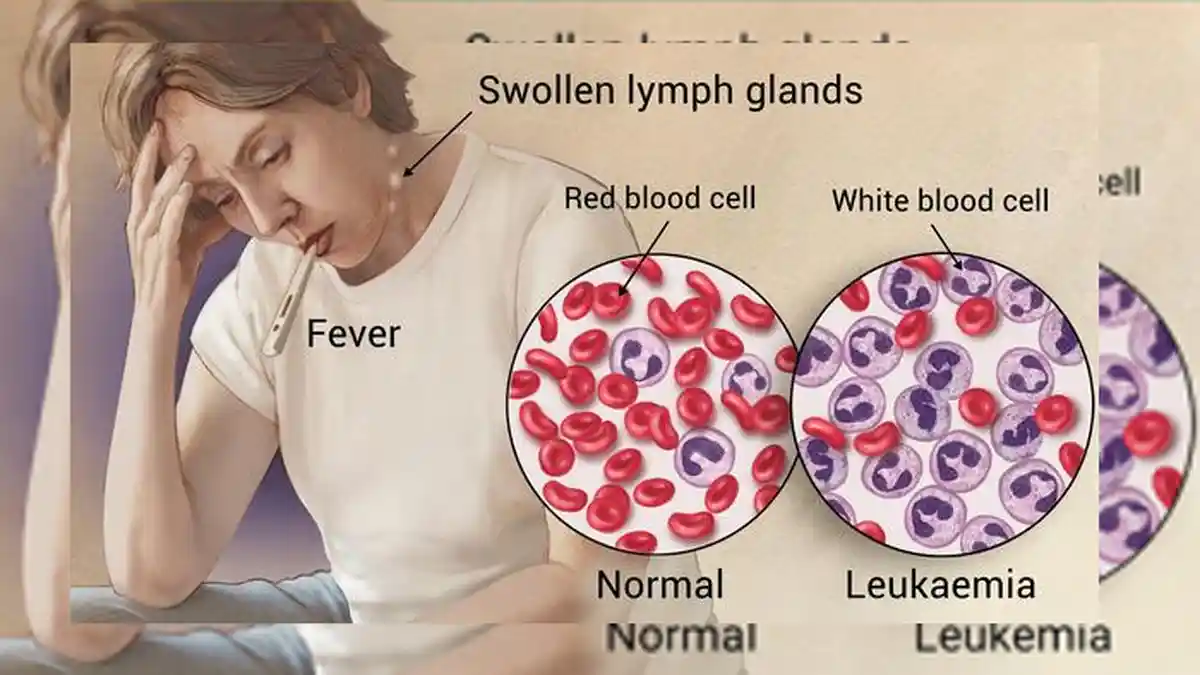 Sering Diabaikan, Kenali 4 Gejala Penyakit Leukemia Sejak Dini