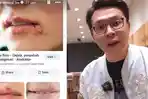 Unggah-Soal-Penyakit-Herpes-di-Bibir-Richard-Lee-Diduga-Sindir-Kartika-Putri-Ungkit-Soal-Penjara.jpg