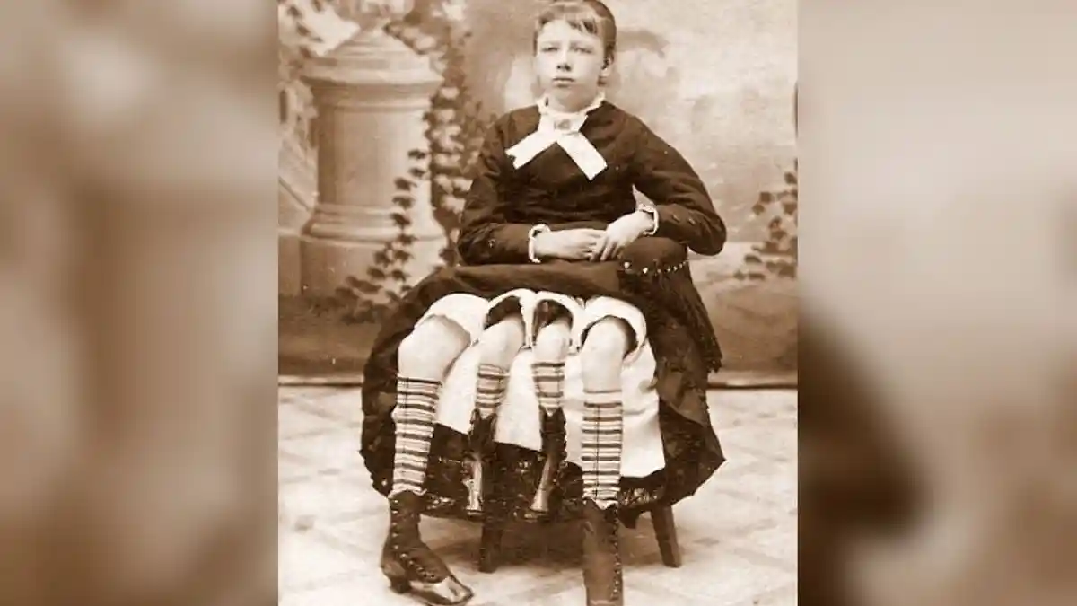 Myrtle Corbin, Wanita Berkaki Empat dan Dua Vagina yang Hidup di Abad 19