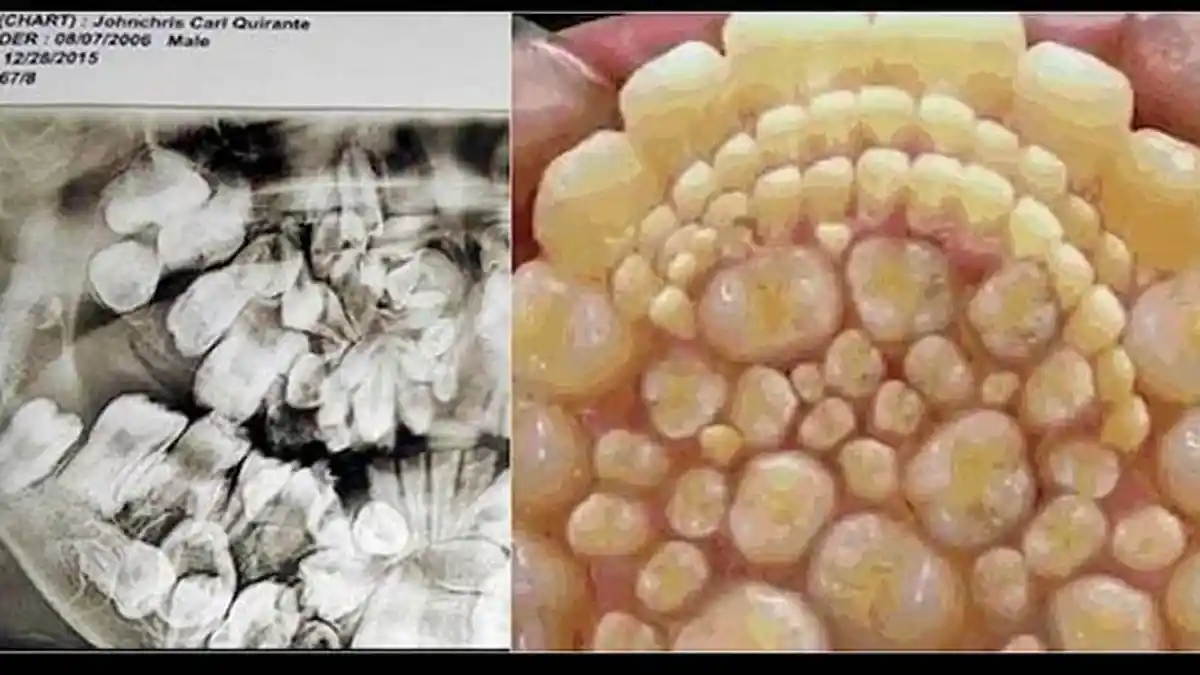 SYOK! Ada Ratusan Gigi Tumbuh Dalam Mulut Bocah ini, Simak yang Dokter Lakukan