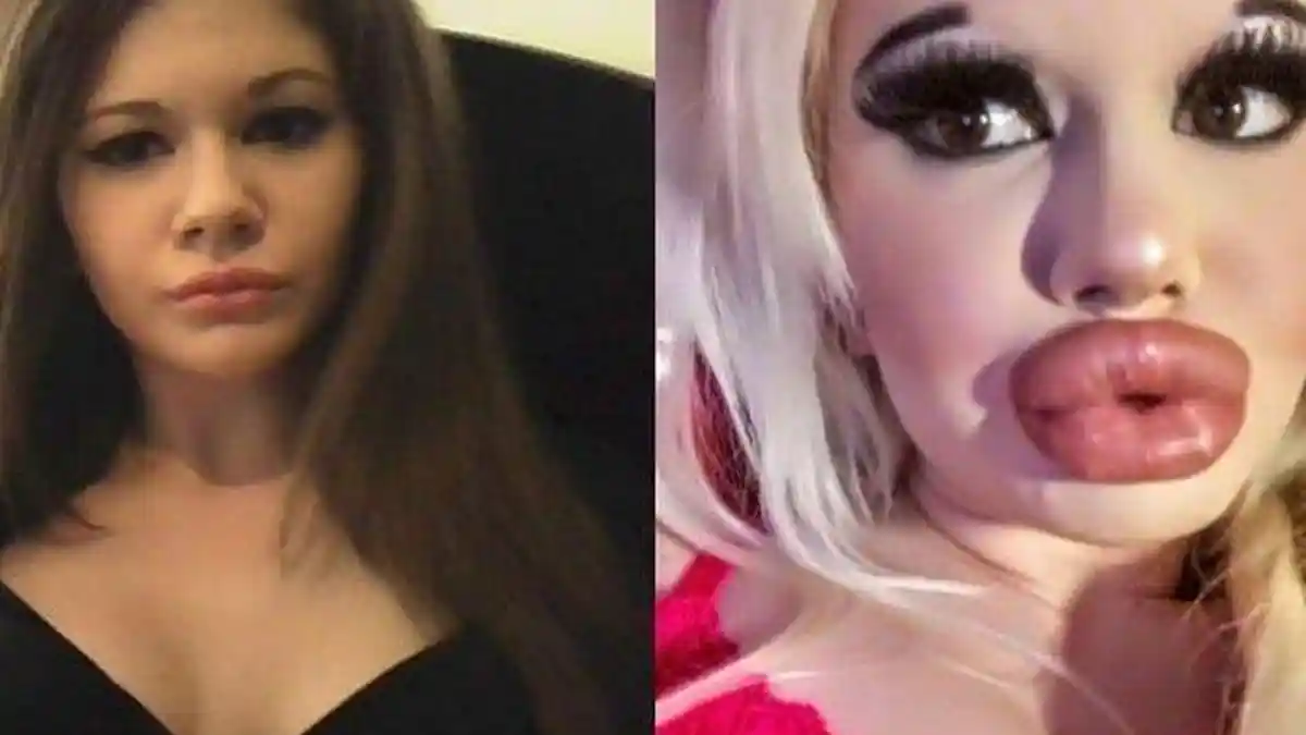 Mahasiswa Cantik Ini 15 Kali Operasi Plastik  Agar Mirip Barbie, Warganet Sebut Hasilnya Mirip Bebek