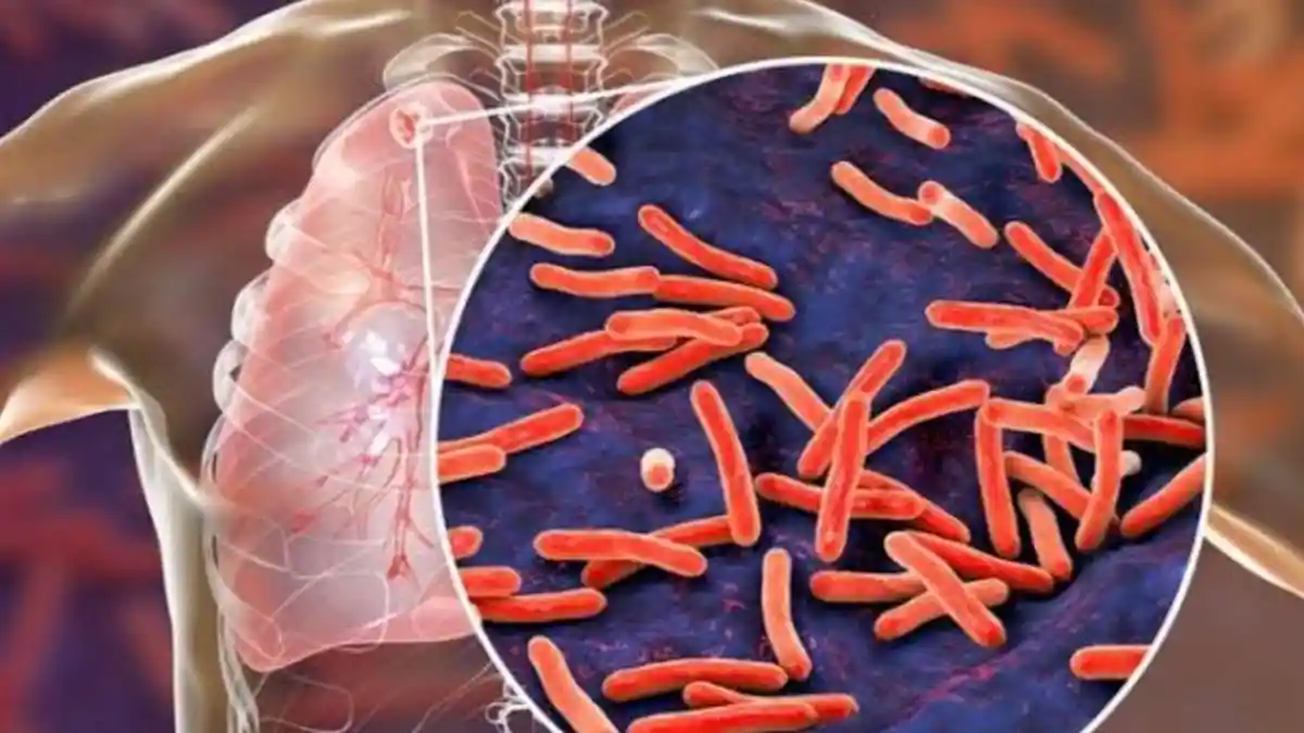 Waspada, Kasus Penyakit TB Paru di Kota Medan Meningkat, Total Per September 2023 Ada 7.400 Kasus