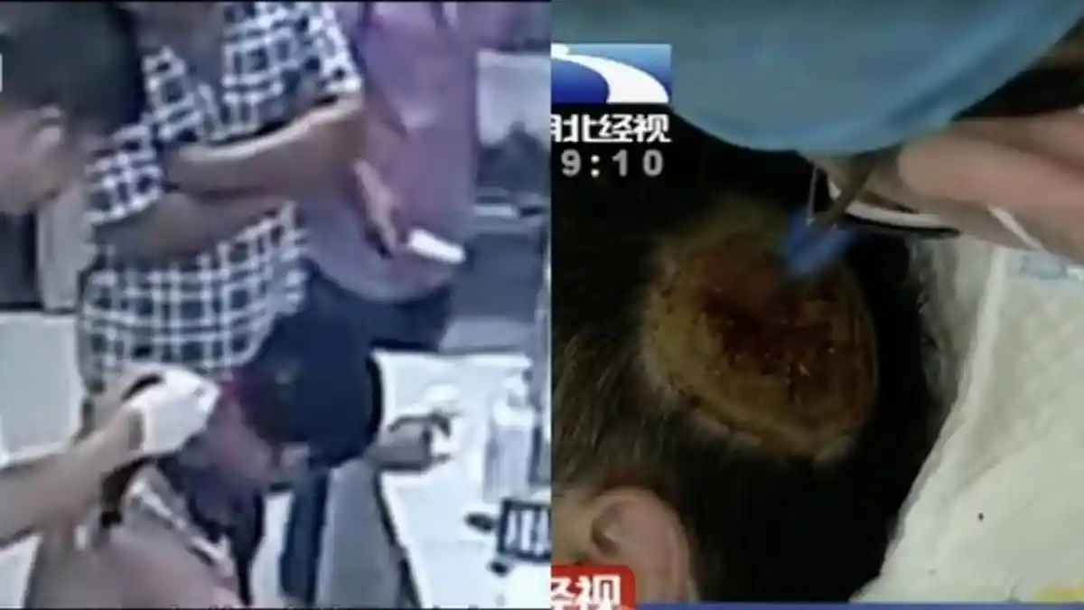 Terlalu Lama di Bawah Bantal, Power Bank Meledak dan Lukai Kepala Seorang Pria, Ngeri!