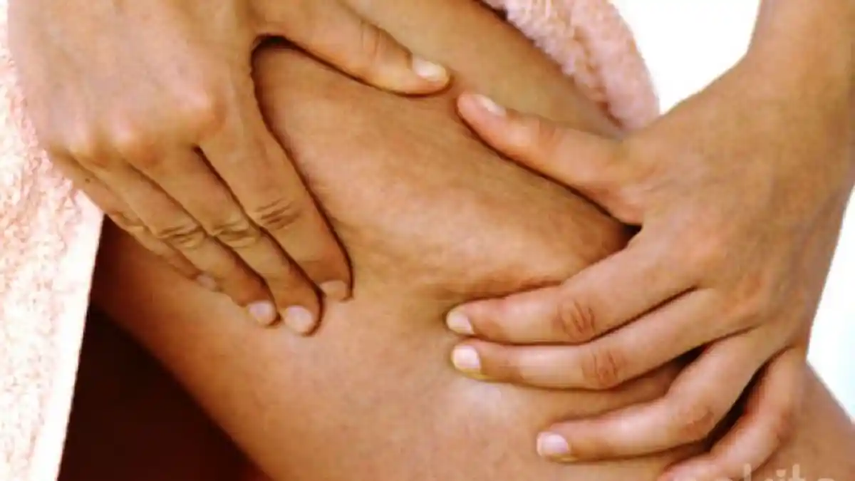 Stretch Mark Membandel, Singkirkan dengan Minyak Zaitun, Simak Caranya