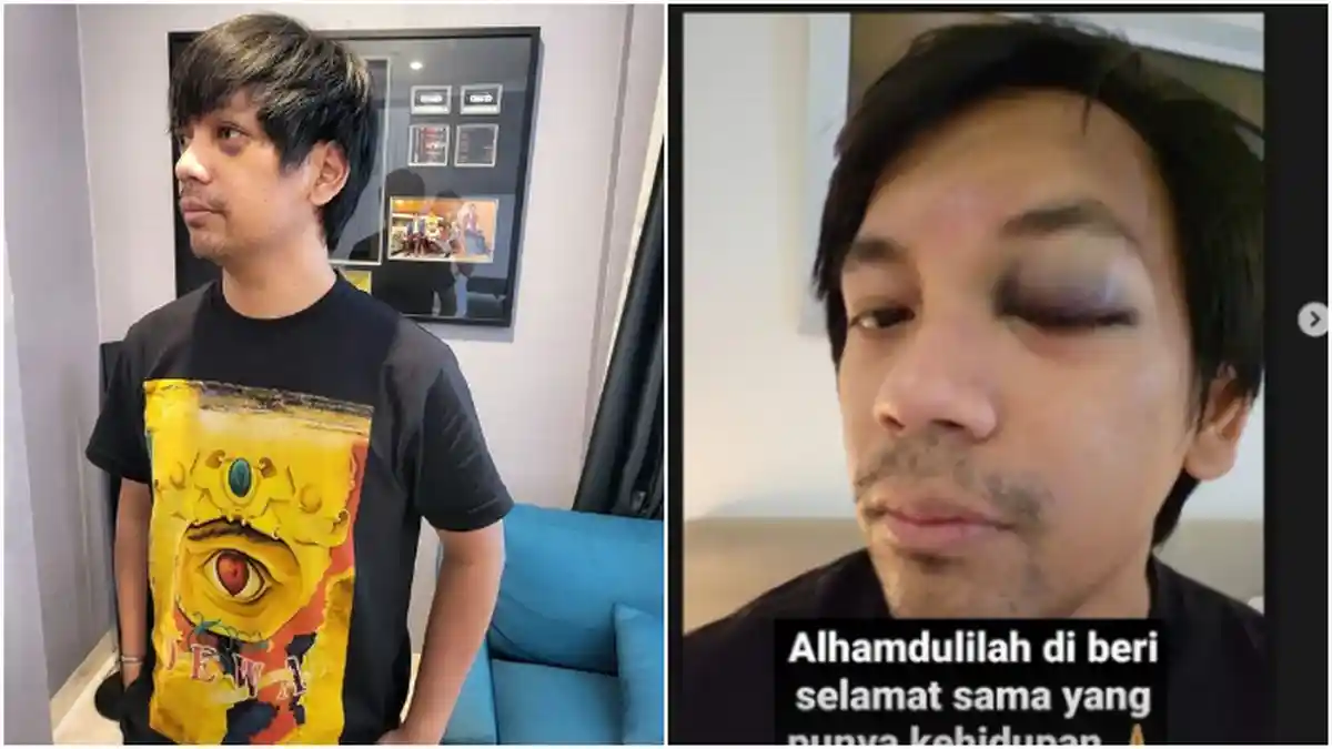 Kondisi Terkini Rian DMasiv Pasca Kecelakaan, Mata Kiri Sudah Terbuka Lebar