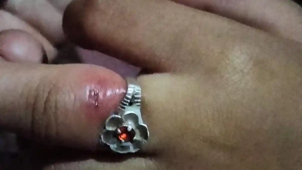 Damkarmat Lampung Selatan Bantu Lepaskan Cincin di Jari Bocah yang Bengkak