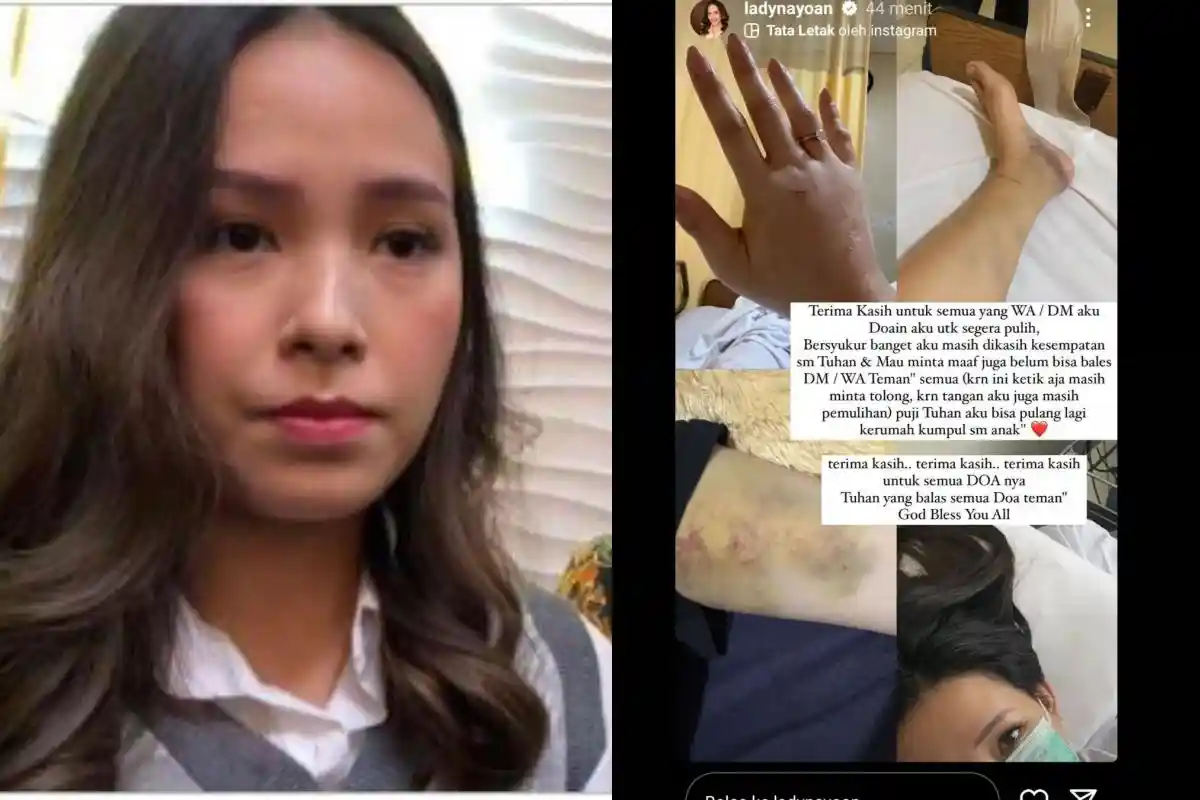 Lady Nayoan Perlihatkan Luka Memar Hingga Bengkak di Tubuh Usai Kecelakaan: Ketik Masih Minta Tolong