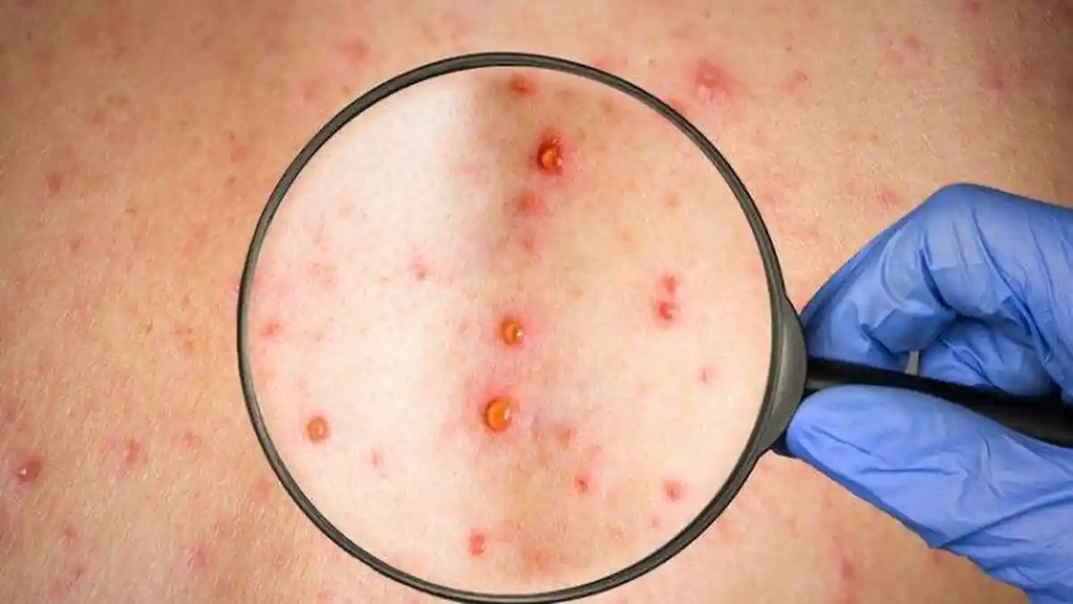 Mengenal Gejala Cacar Monyet pada Tubuh, Kini Lebih dari 1.000 Kasus Monkeypox