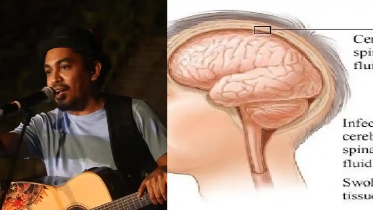 Mengenal Penyakit Meningitis Mulai Gejala Ringan hingga Berat: Penyebab Glenn Fredly Meninggal