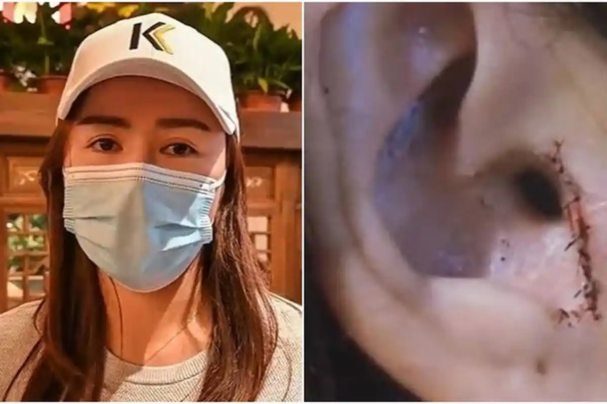 Wanita Ini Syok saat Lihat Cermin Tulang Rawan di Kupingnya Sudah Tak Ada, Ternyata Ini Penyebabnya