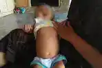 tumor-bayi-6-bulan-lombok-tengah-2.jpg