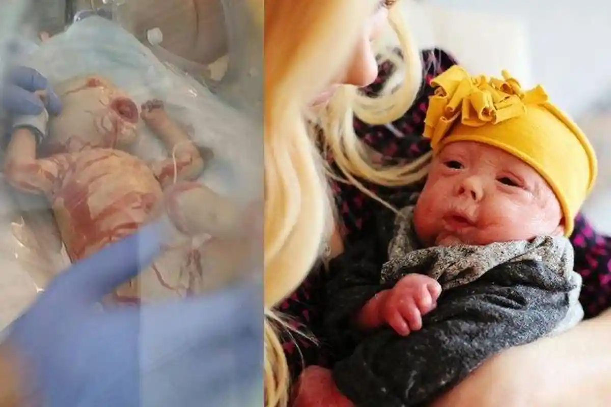 Dulu Bayi Lahirnya Mengerikan Kulit Mengelupas bak Ular, Tak Disangka Kini Jadi Model Iklan Digemari