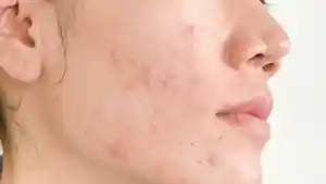jerawat-perempuan.jpg