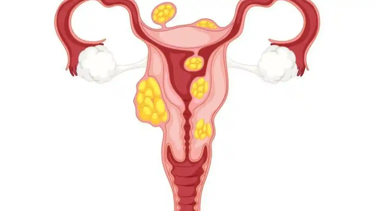 Wanita Wajib Tahu! Ternyata Ini Pengobatan Herbal untuk Penyakit Miom ala dr Zaidul Akbar 