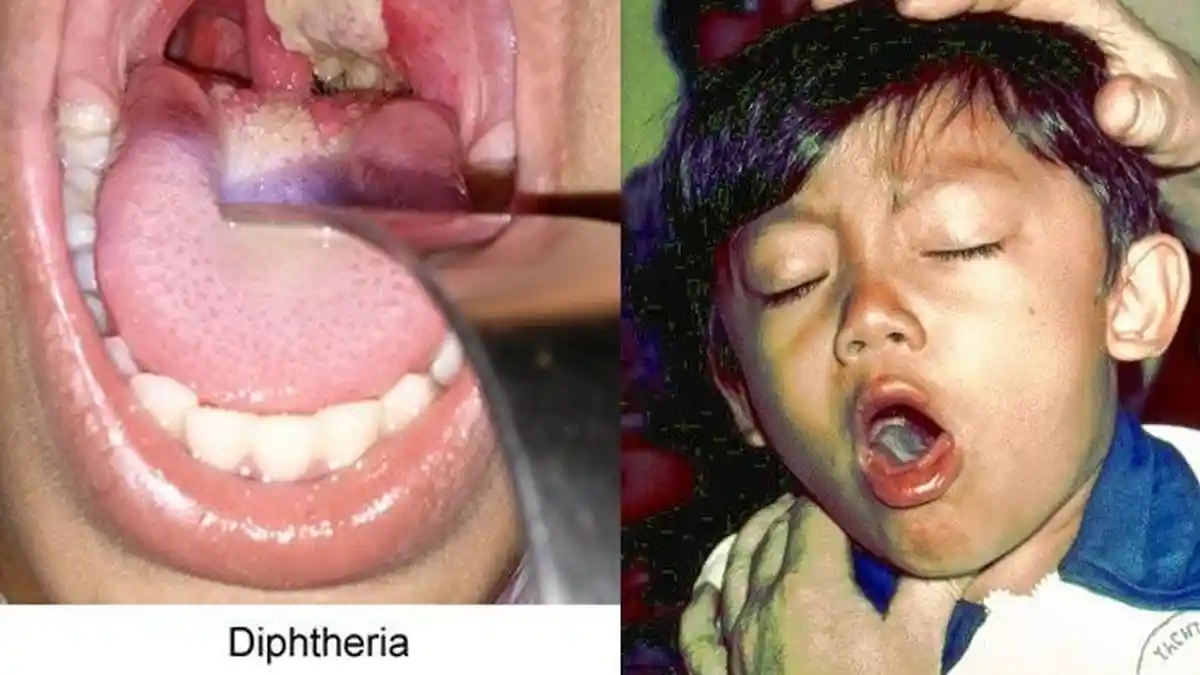 Apa Penyebab Difteri? Simak Langkah-Langkah Pencegahannya, Ingat! Penyakitnya Sangat Mudah Menular