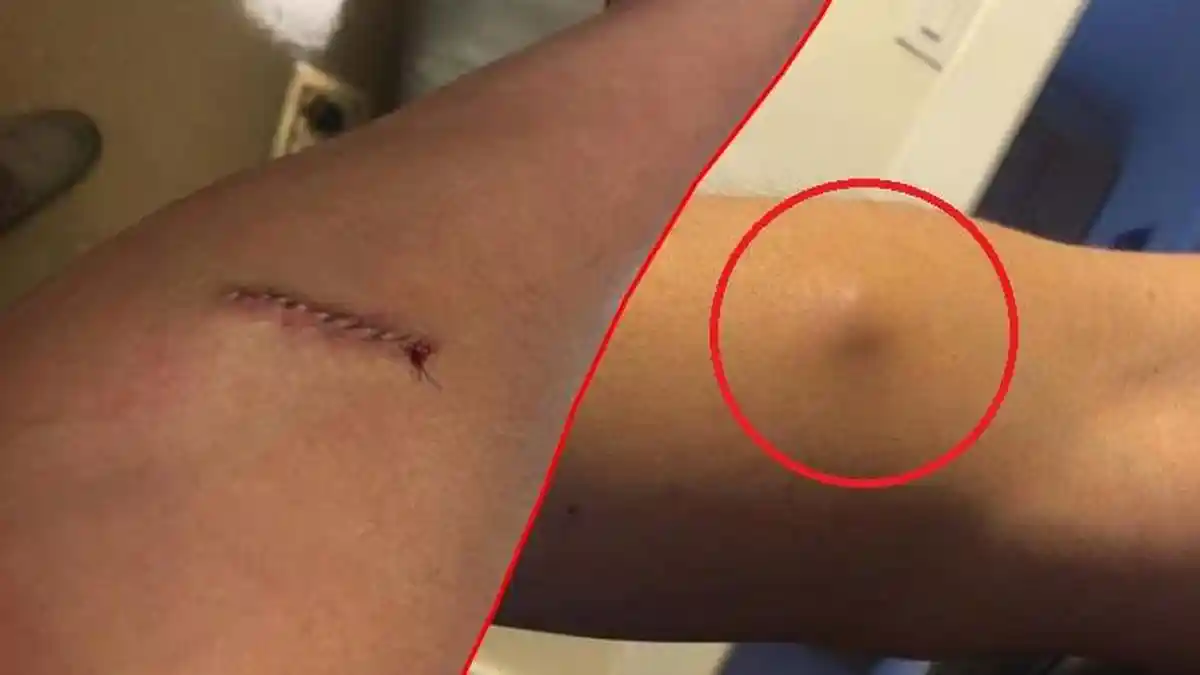 Aneh! Dokter Bedah Benjolan di Tangan Pria Ini, Dokter Heran Saat Melihat Isinya