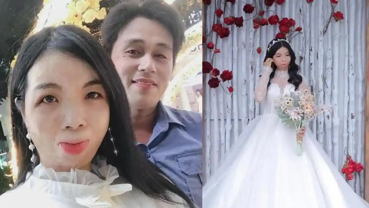 Gadis Berwajah Rusak Cari Jodoh di Facebook, Tak Sangka Ada Pria Tertarik, 1 Bulan Pacaran Menikah
