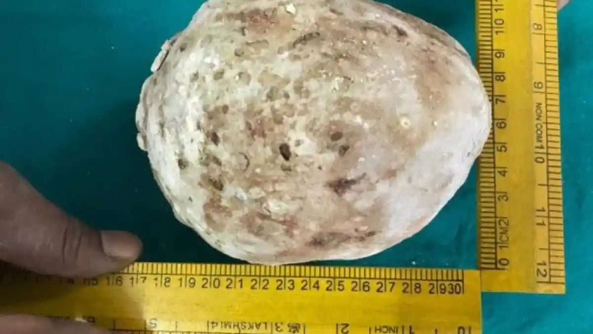 ALAMAK. Mengeluh Sakit Ternyata dalam Perut Pria Ini Ada Batu Seberat 1,4 Kg