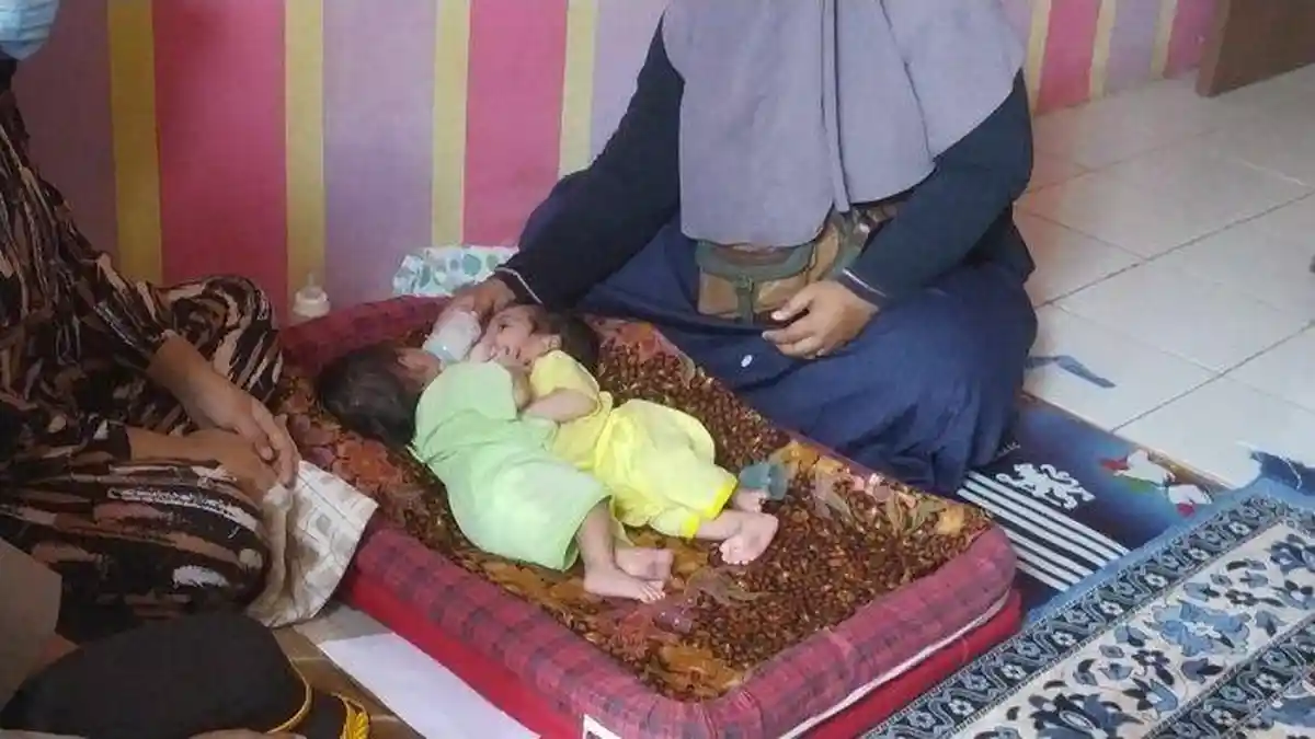 Curhat Ibu Bayi Kembar Siam Punya Dua Jantung Satu Hati: Berharap Segera Dilakukan Operasi Pemisahan