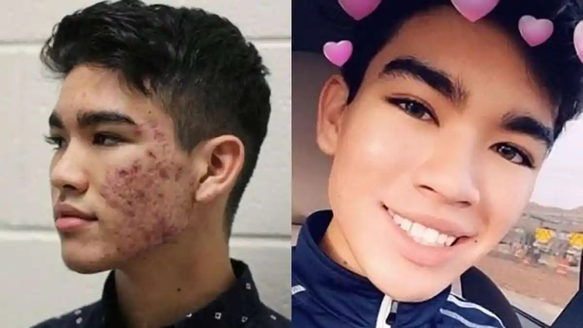 Viral, Pria ini Bagi Tips Murmer Hilangkan Sendiri Jerawat Sampai Mulus, Tak Perlu Pergi ke Klinik!