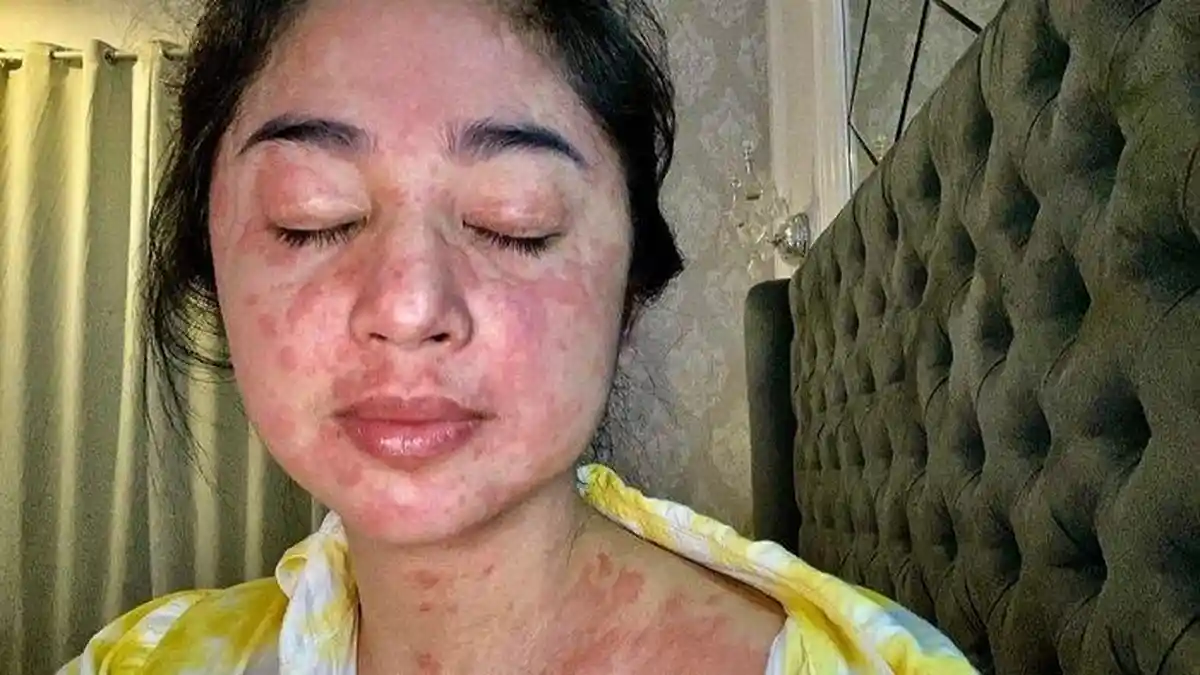 Dokter Dunia Temukan Tanda Baru Covid-19, Belajar dari Dewi Perssik, Hati-hati Jika Muncul Tanda Ini