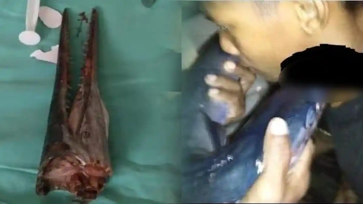 Pelajar SMP Pulang Setelah Mancing di Laut, Lehernya Tertusuk Ikan tapi Masih Sadar dan Bisa Jalan