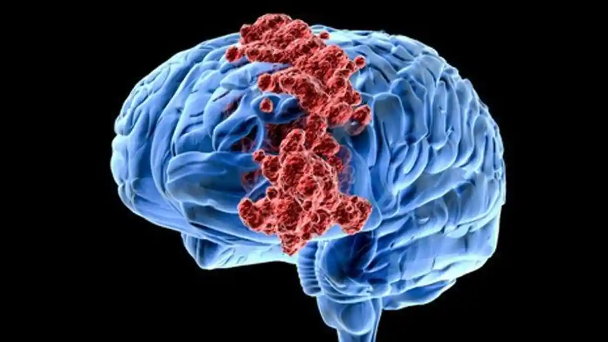 Sering Disepelekan Gejala Sakit Kepala Terus Menerus Jadi Pertanda Tumor Otak