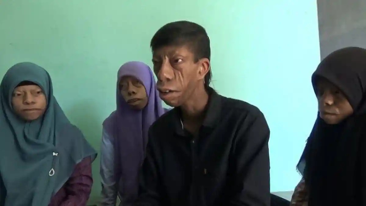 Warga Asahan Mendadak Viral di TikTok, Tak Malu Meski Idap Sindrom Langka: Kami Bersyukur