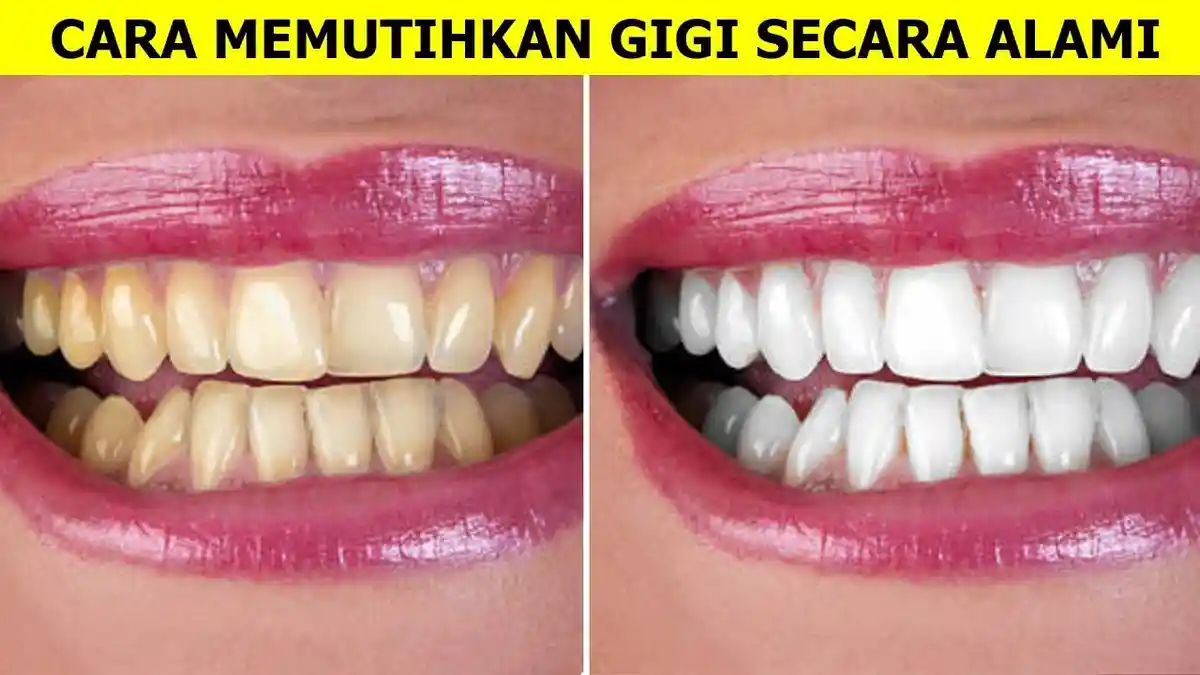 5 Cara Mudah dan Efektif Mengatasi Gigi Kuning Agar Menjadi Putih, Bersih dan Sehat