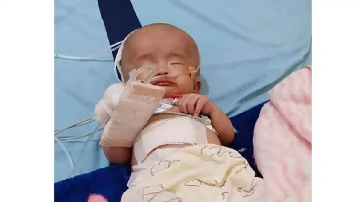 Bayi Penderita Hidrosefalus di Lampung Selatan Butuh Bantuan Dermawan