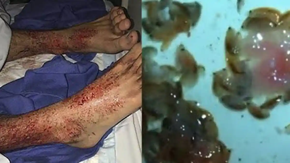Ingat Pria Kakinya Digigit Kutu Laut? Ternyata Punya Keluarga yang Serangannya Juga Mengerikan