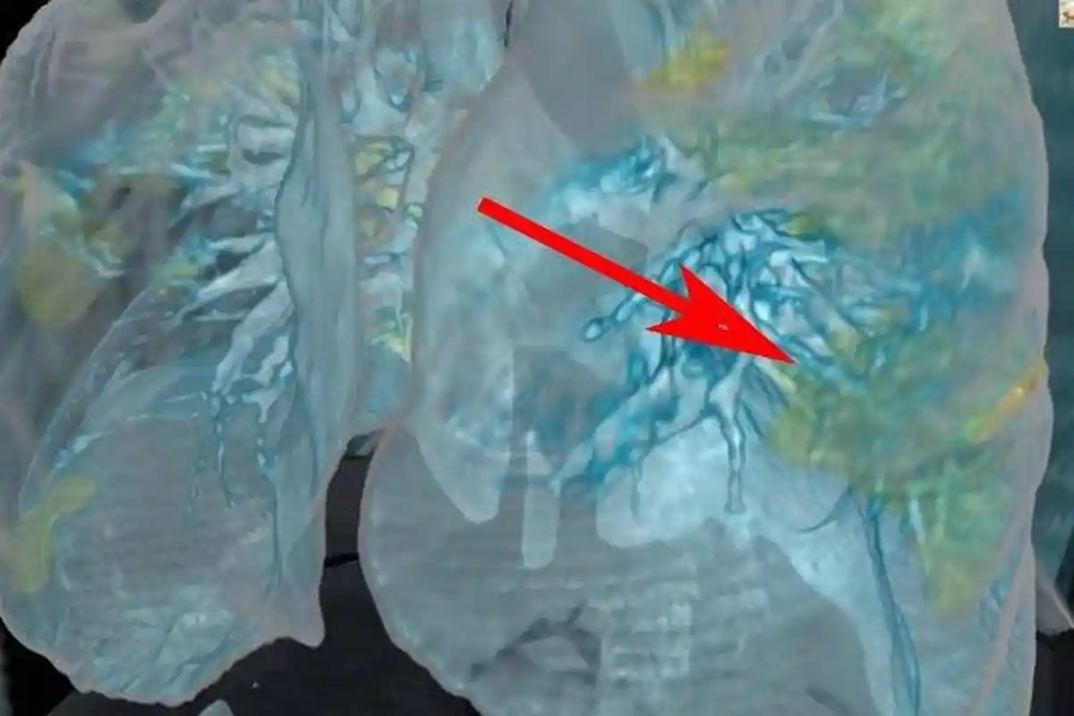 Pasien Isoman Wajib Tahu, 5 Tanda Virus Corona Sudah Menyerang Paru-paru, Picu Infeksi Mematikan