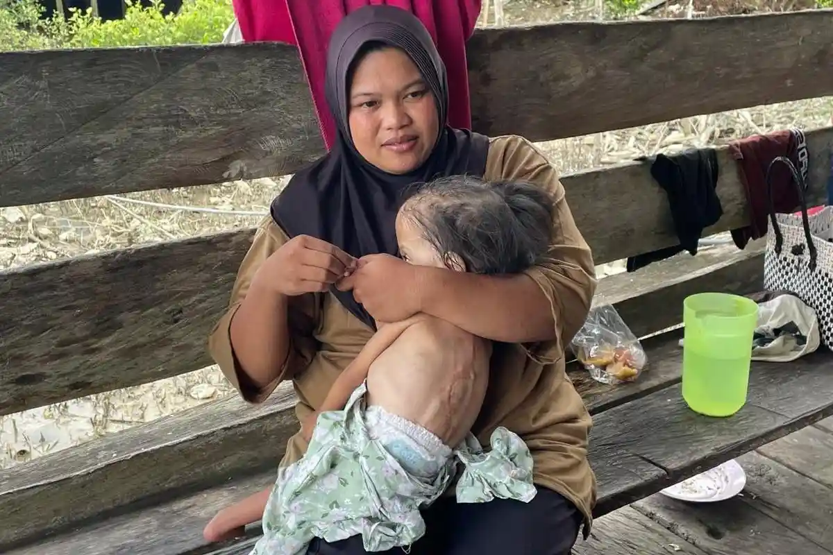 3 Penyakit Langka Hinggapi Farah Sejak Lahir, Bocah Asal Nunukan Kaltara ini Hidup di Tepi Harapan