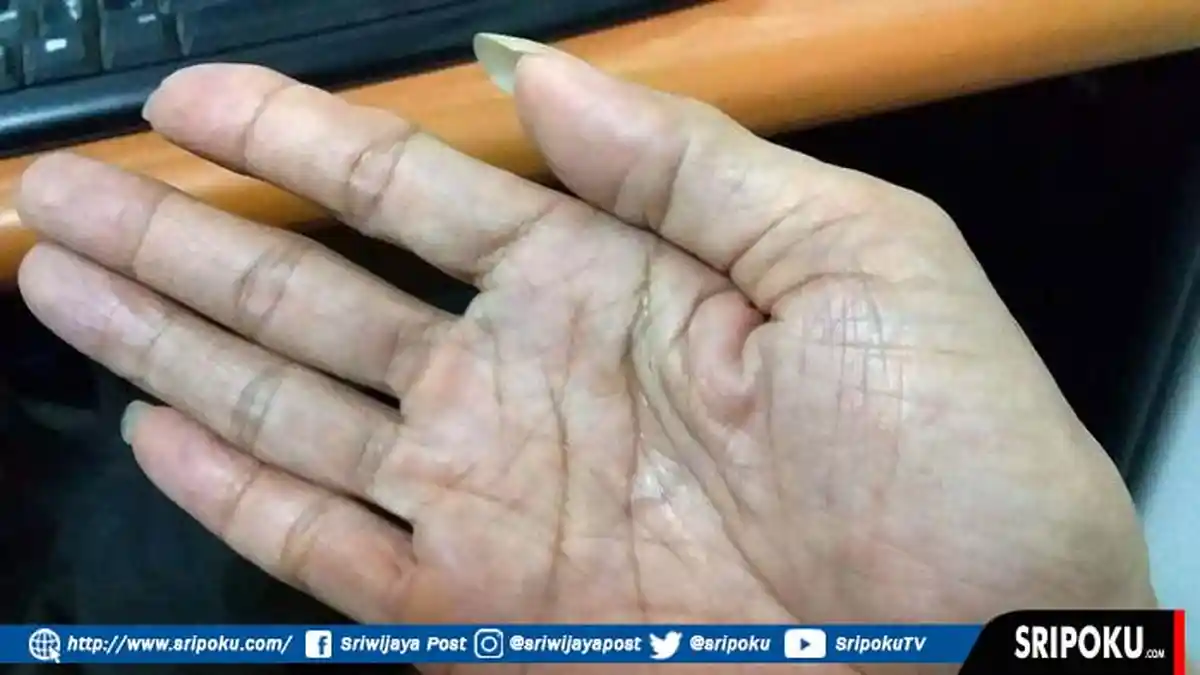 Bukan Lemah Jantung! Telapak Tangan Selalu Berkeringat dan Basah Menurut Medis, Ini Penyebabnya
