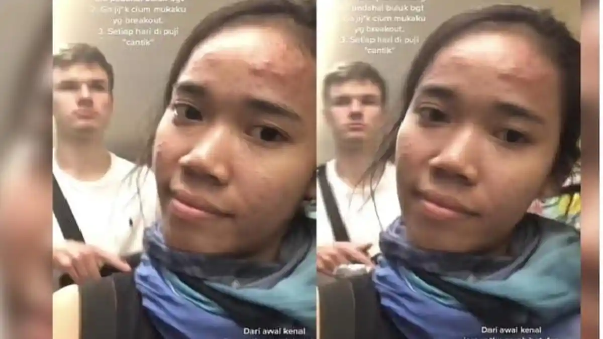 Punya Banyak Jerawat, Curhat Wanita Minder Dipacari Bule: Gak Jijik Cium Muka