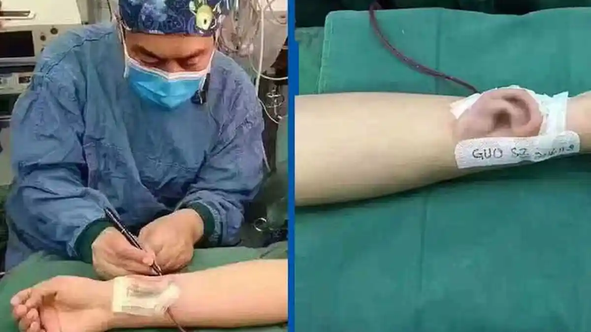 Aneh Tapi Nyata! Dokter Pasang Telinga di Tangan Pasien, Hasilnya Mengejutkan