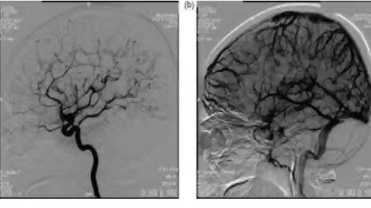 Cek Penyebab Pusing Berkepanjangan dengan DSA Cerebral di Mayapada Hospital Surabaya