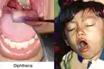 waspada-wabah-difteri-yang-sebabkan-kematian_20171212_232436.jpg
