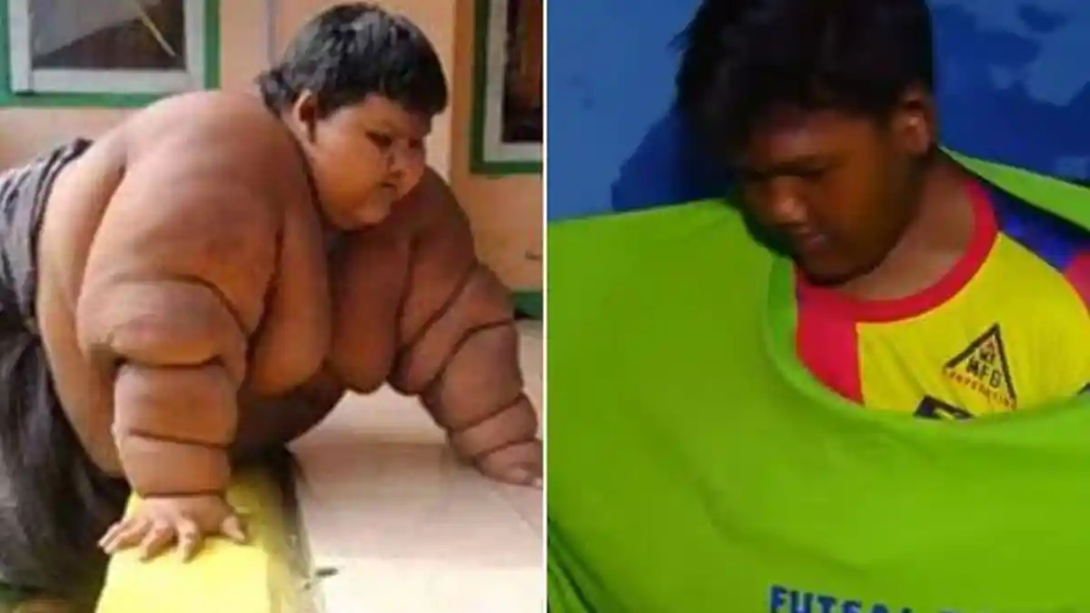 Begini Cara Diet Arya Permana, Bocah Obesitas Viral yang Mampu Turunkan Berat Hingga 102 Kg