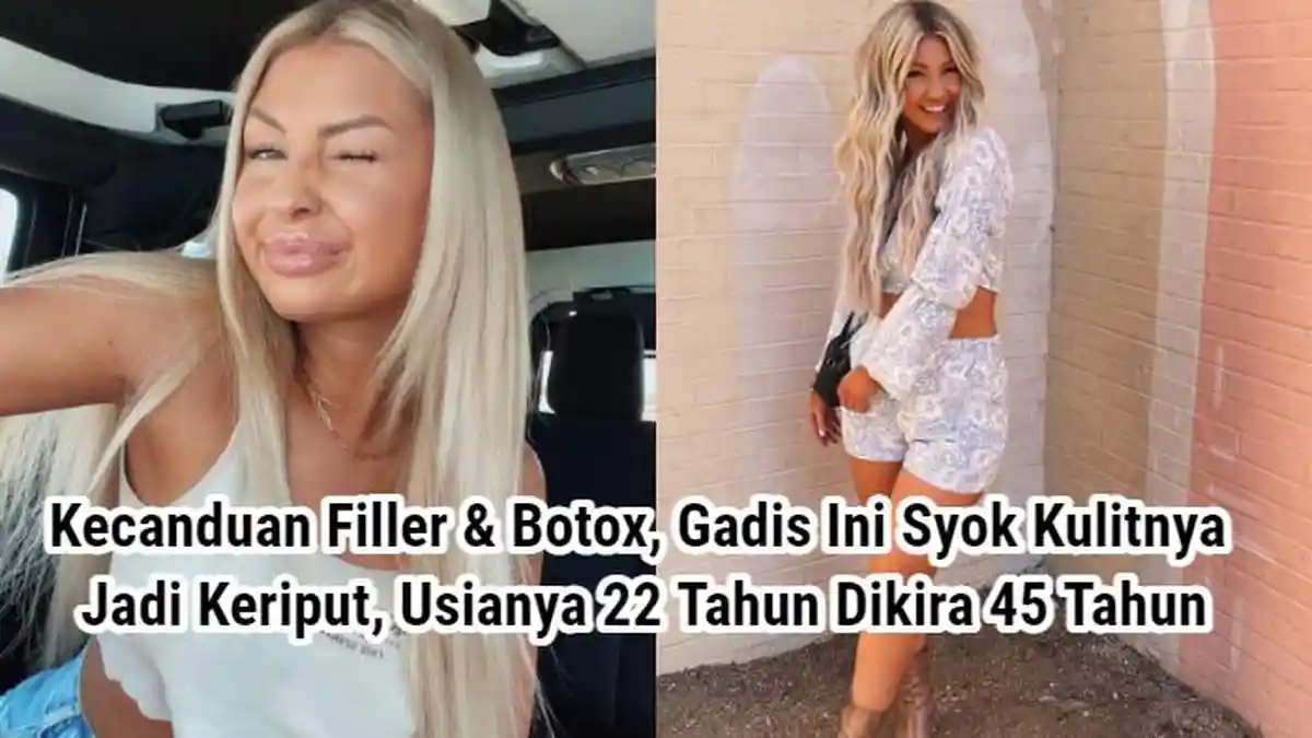 Kecanduan Filler & Botox, Gadis Ini Syok Kulitnya Malah Keriput ...