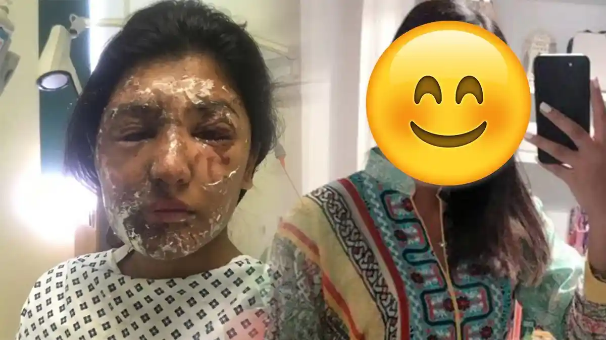 Disiram Air Keras hingga Terbakar & Alami Trauma, Wanita Ini Bangkit, Begini Penampilannya Sekarang