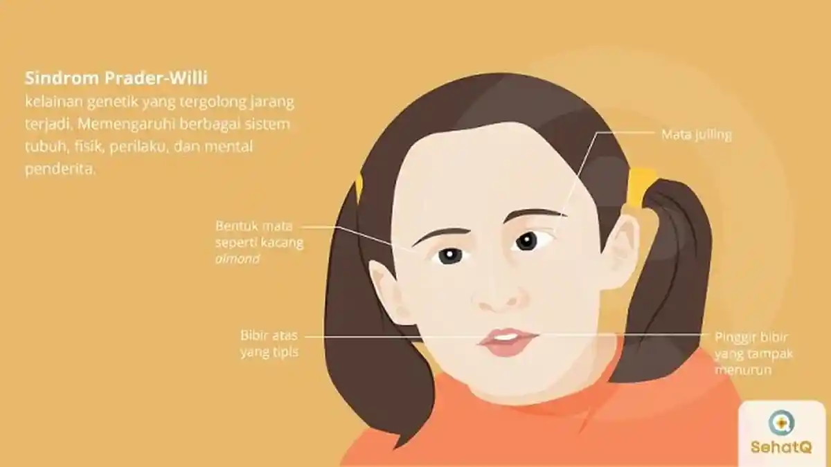 Apa itu Sindrom Prader-Willi ? Kelainan Genetik pada Anak Bungsu Oki Setiana Dewi, Berikut Gejalanya