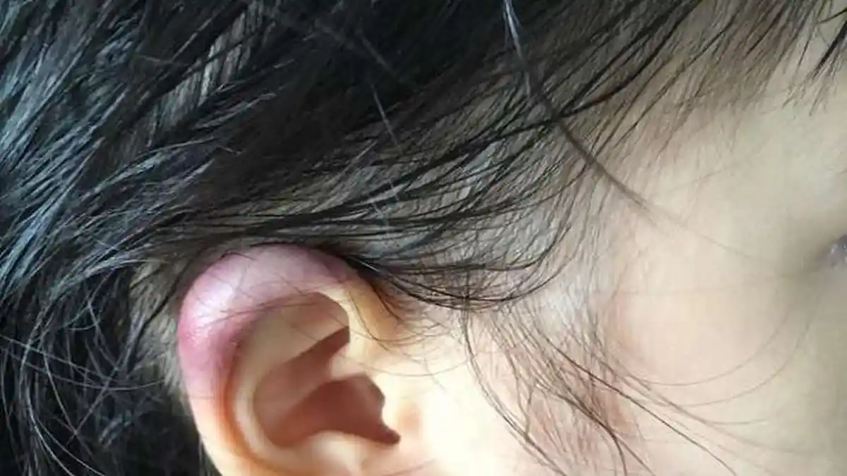 Diduga Dijewer Gurunya, Telinga Siswa TK Ini Memar Hingga Bermimpi Buruk