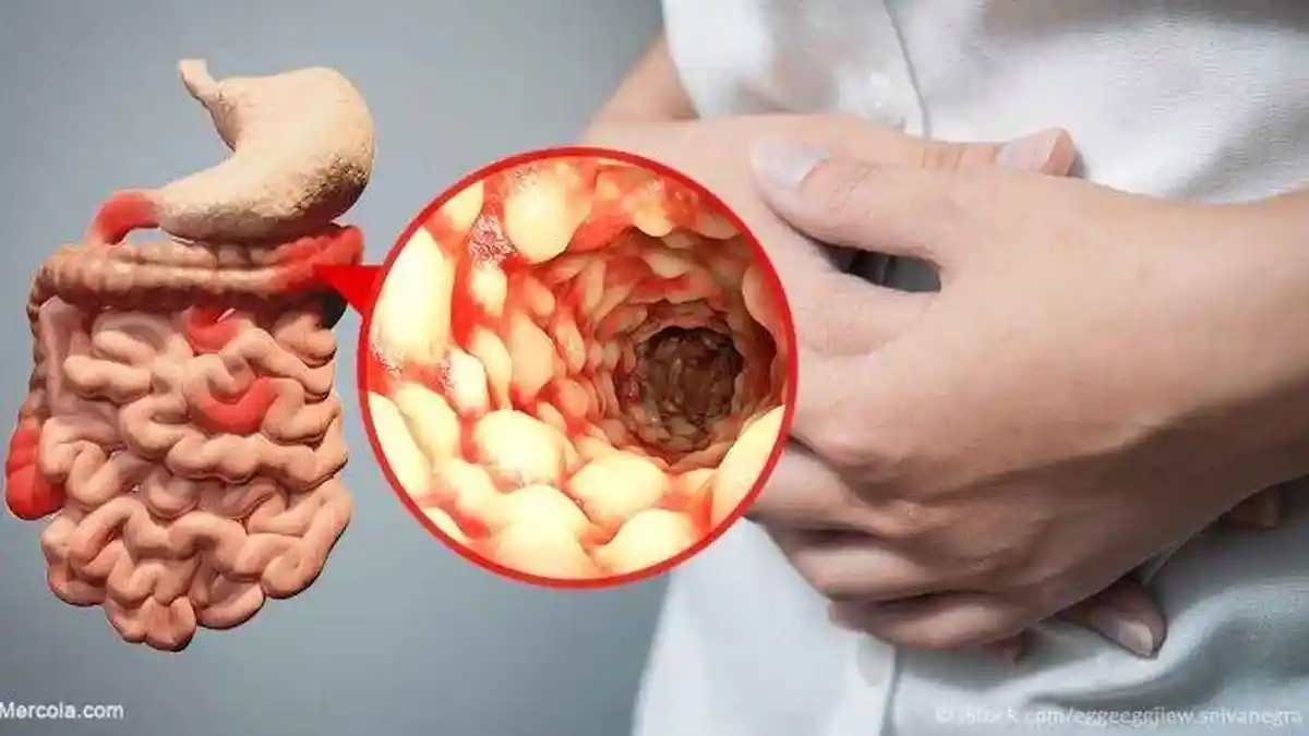 9 Bahan Alami yang Baik Dikonsumsi untuk Sembuhkan Kanker Usus, dari Bawang Putih hingga Bayam