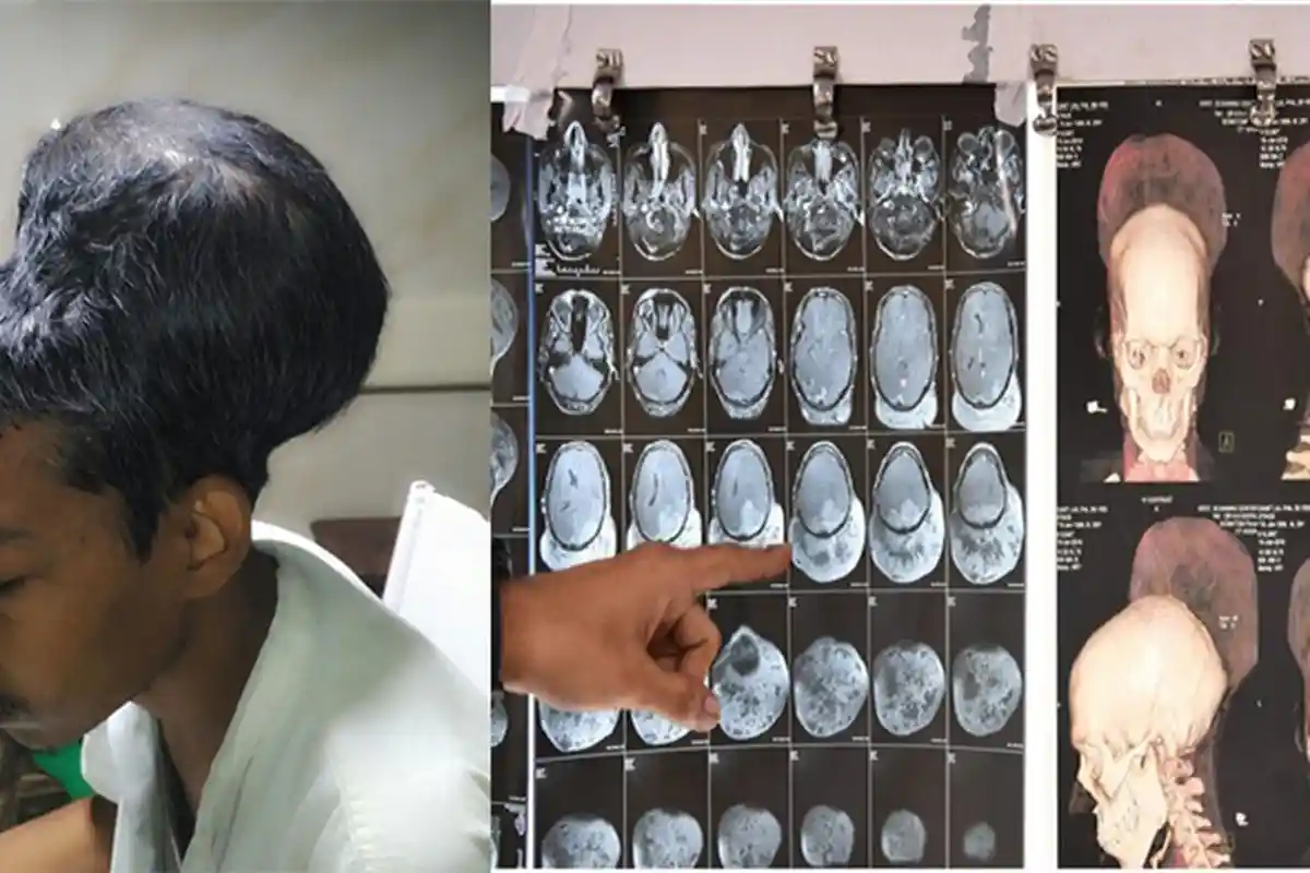 HINDARI! 5 Jajanan Anak Pemicu Tumor Otak, Nomor 2 Sangat Digemari Anak-Anak